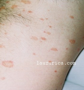 Lesiones de Pitiriasis Rosada en tronco