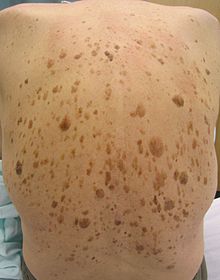 Signo de Leser-Trelat