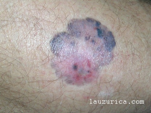 Melanoma en regresión avanzada. Suele ser indicativo de mal pronóstico.