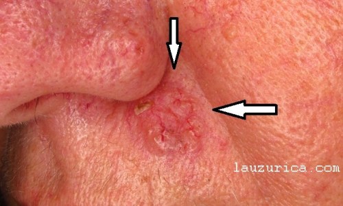 Carcinoma basocelular de más de 2 años de evolución