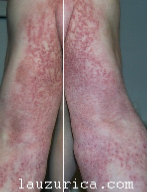 Simetría de afectación en brazos