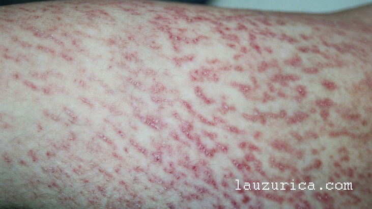 Lesiones lineales en brazos