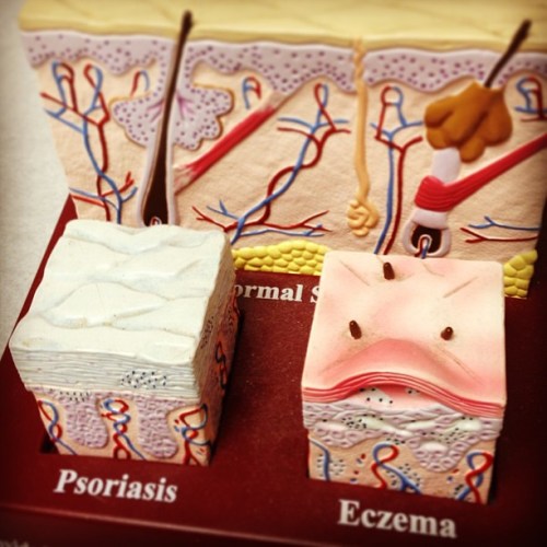 Eczema y psoriasis no son lo mismo, como queda reflejado en esta maqueta en tres dimensiones.