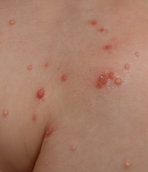 tratamiento de cicatrices molusco contagioso