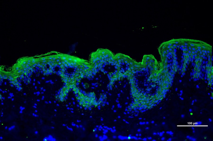 Biopsia de piel. Inmunofluorescencia