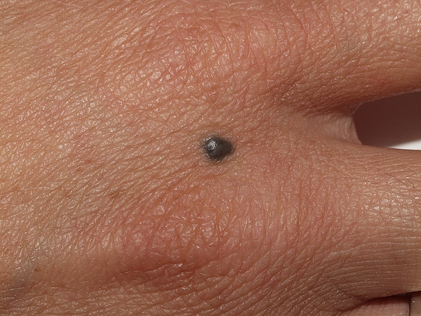 Biopsia de piel. Nevus azul