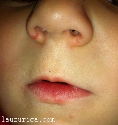 Dermatitis periorificial granulomatosa infantil. Lesiones en nariz y mentón