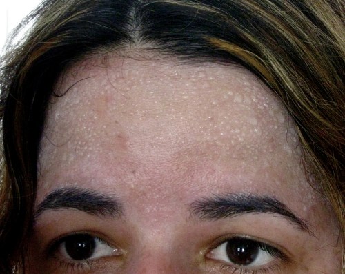 Aumento del sudor en frente típico de la hiperhidrosis craneofacial