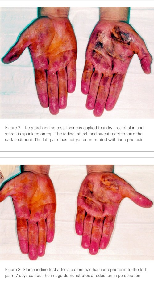 Amento del sudor, hiperhidrosis y toxina botulínica. Test de Minor o de yodo-almidón.