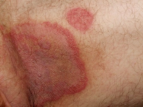 Tiña inguinal. Placa con borde activo y lesión satélite