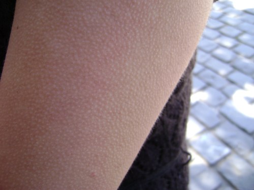 Piel de gallina y hamartoma de músculo liso.