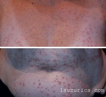 Milaria rubra en adulto.