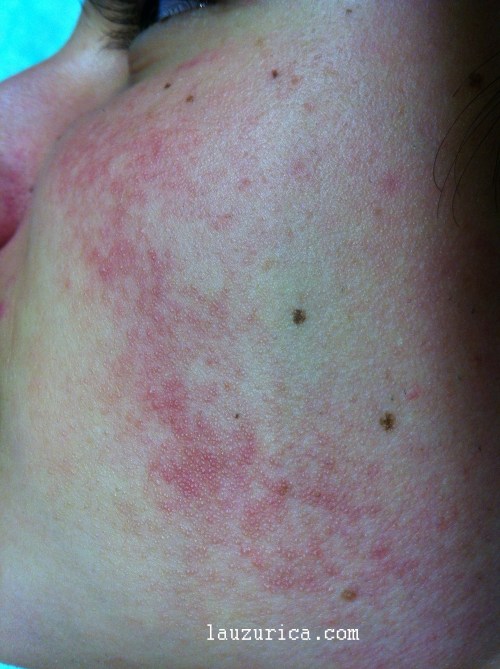 Queratosis pilar roja. Parche rojo en mejilla y detalle de pequeñas pápulas de queratina