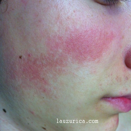 Parche rojo en mejilla y detalle de pequeñas pápulas de queratina.