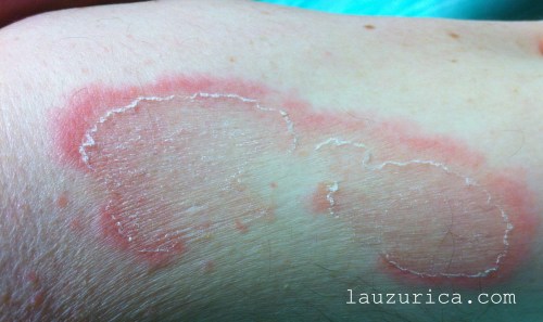 Eritema anular centrífugo