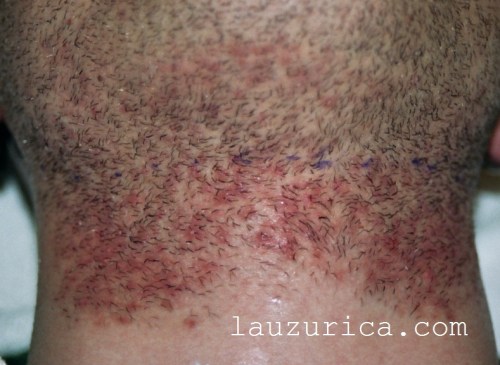 Pseudofoliculitis en cuello.