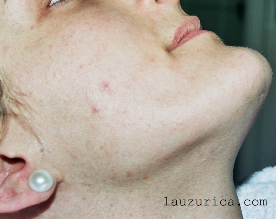 Buen resultado, tras 1 año de su 7ª sesión con luz intensa pulsada