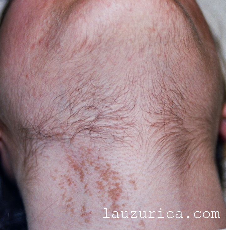 Reclutamiento de pelo, lejos de la zona de aplicación del láser