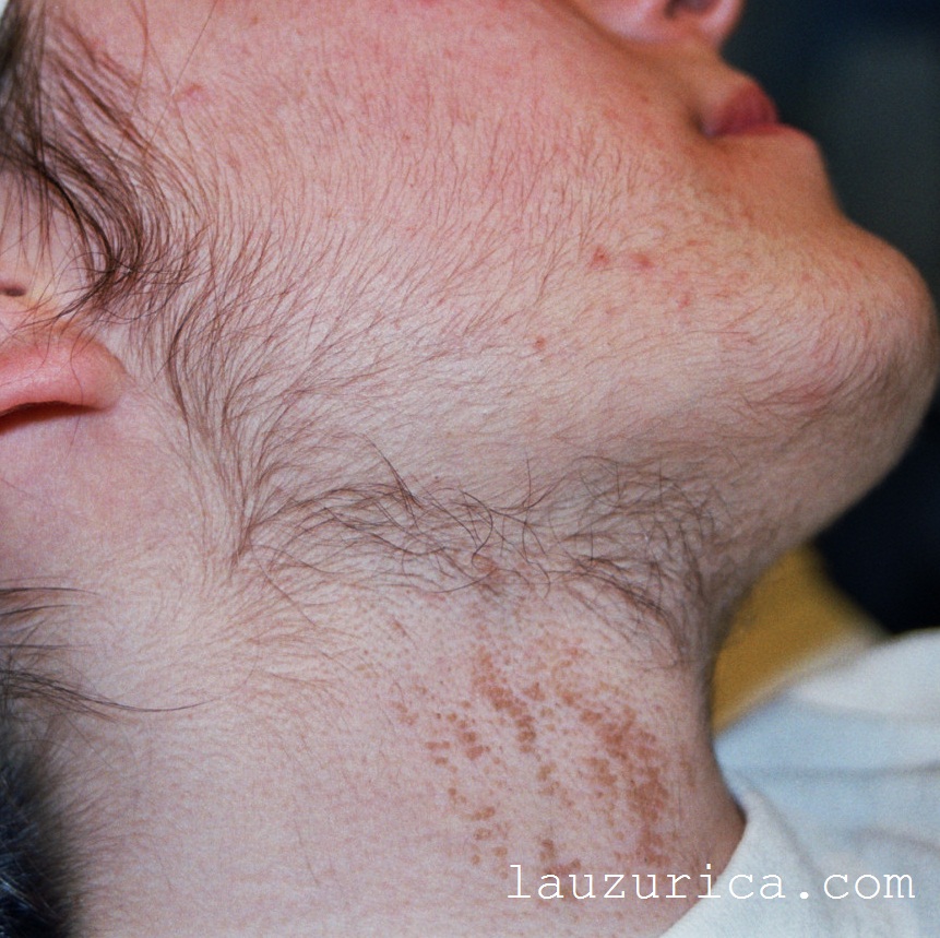 Reclutamiento de pelo, lejos de la zona de aplicación del láser