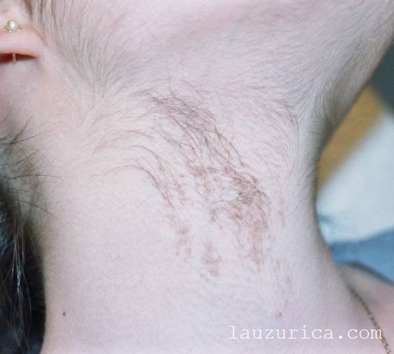 Nevus piloso en cuello y vello en cara