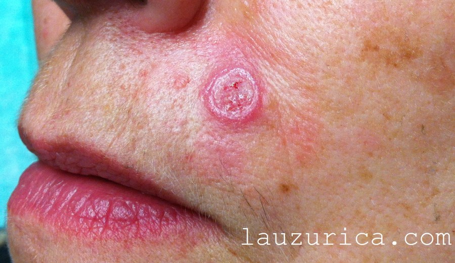 Aspecto a los 7 días