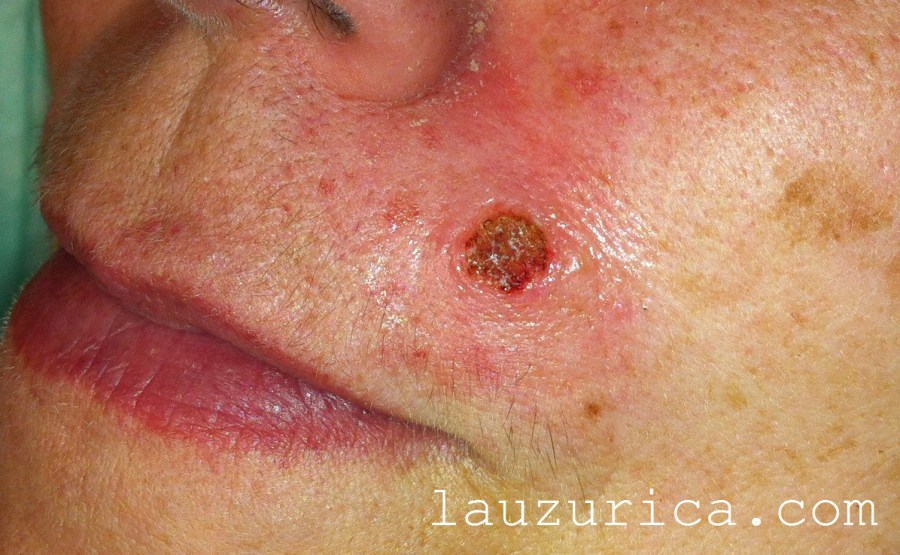 Aspecto inmediato, tras la eliminación del nevus.