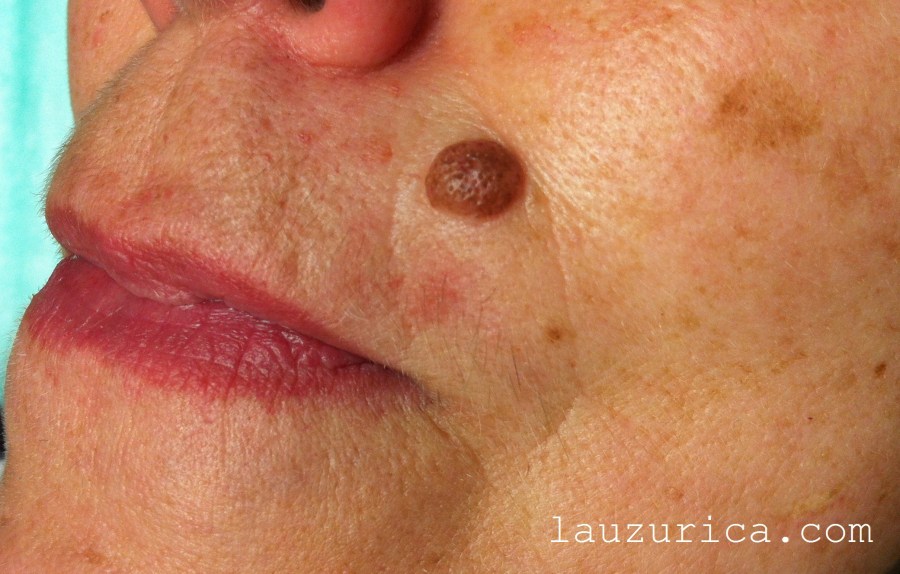 Nevus de gran tamaño en labio