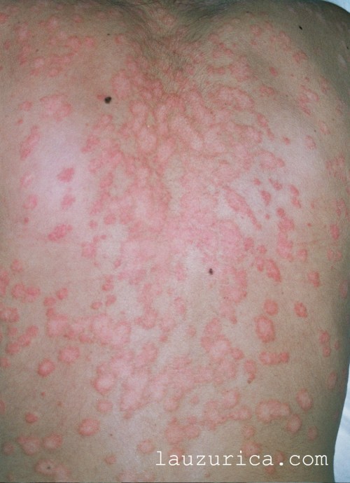 Pitiriasis versicolor inflamatoria