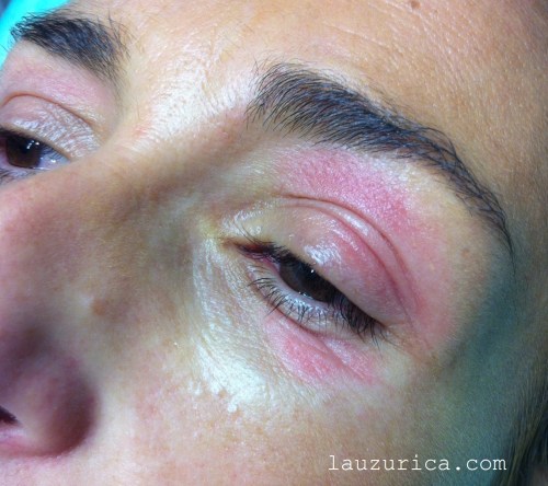 Irritación de párpados por aceite del árbol del te