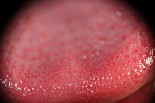 Lengua irritada por deficit de hierro; relación con piel, uñas y pelo. 