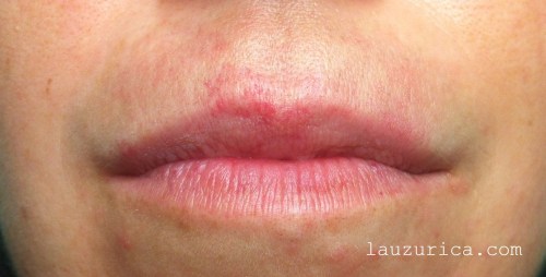 Mancha del bigote después del tratamiento