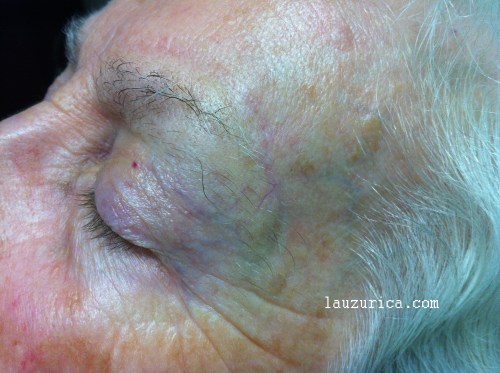Aspecto tras la extirpación del queratoacantoma
