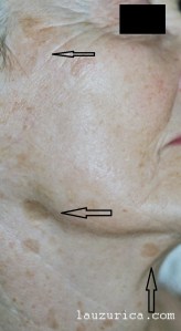 Piel fotoenvejecida con gran número de léntigos solares.