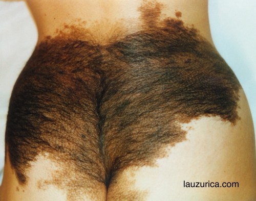 Nevus gigante en zona lumbar-glutea