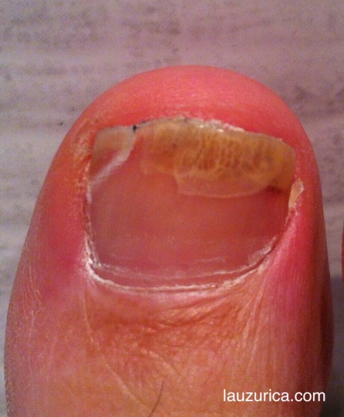 Hematoma subungueal desplazado desde su origen en zona media