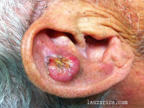 Carcinoma epidermoide en pabellón auricular