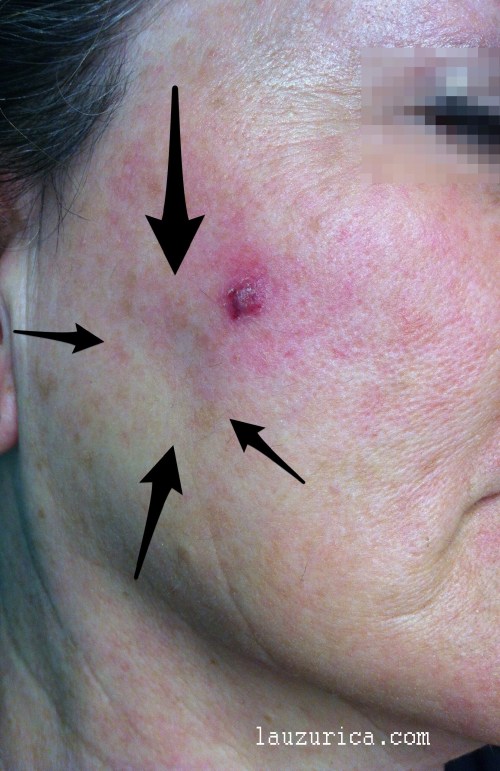 Hematoma y hundimiento facial