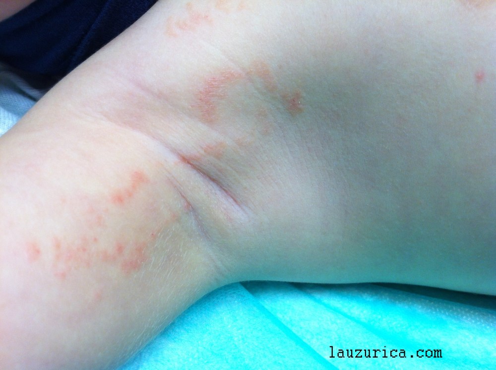 Liquen Estriado Una Dermatosis Lineal Cuaderno En Piel liquen-estriado-una-dermatosis-lineal-cuaderno-en-piel