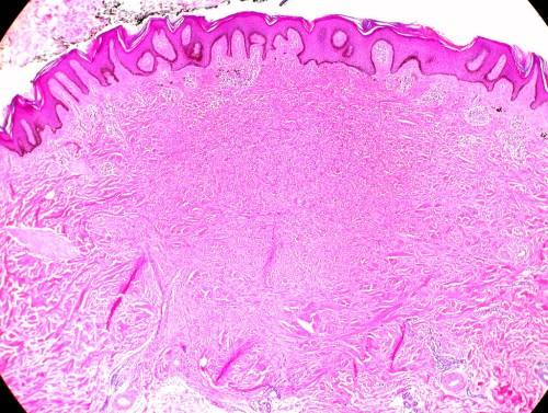 Imagen histológica del dermatofibroma