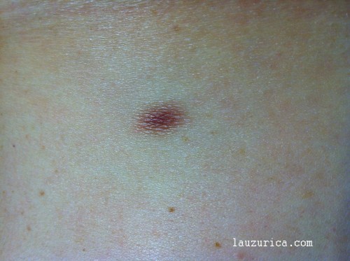 Dermatofibroma sin relieve con aspecto de lunar.