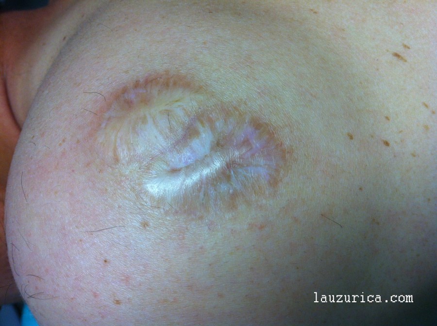 Cicatriz residual tras uso de crema con Bloodroot