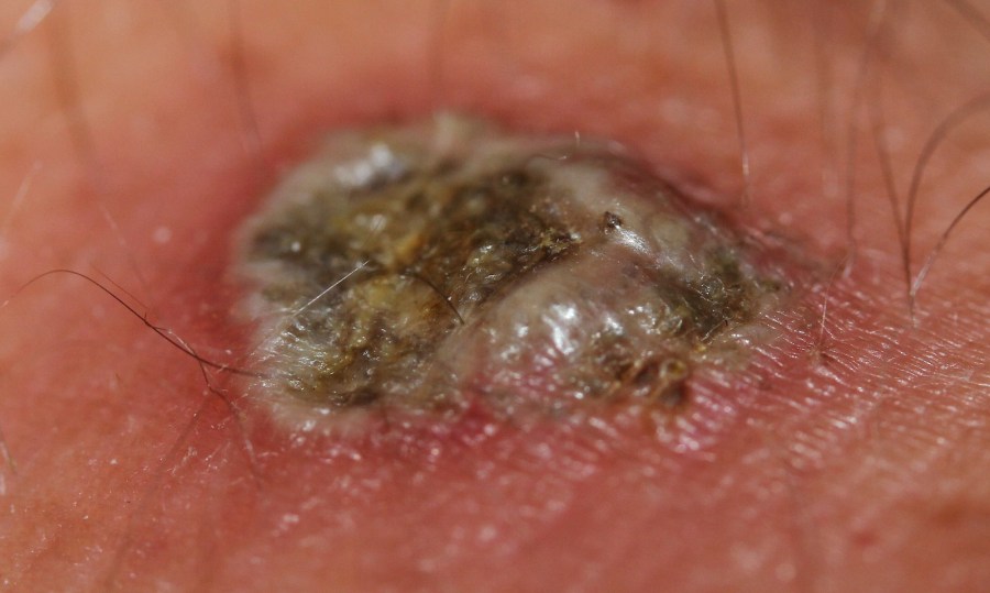 Escara a los 4 días de usar crema con Bloodroot.