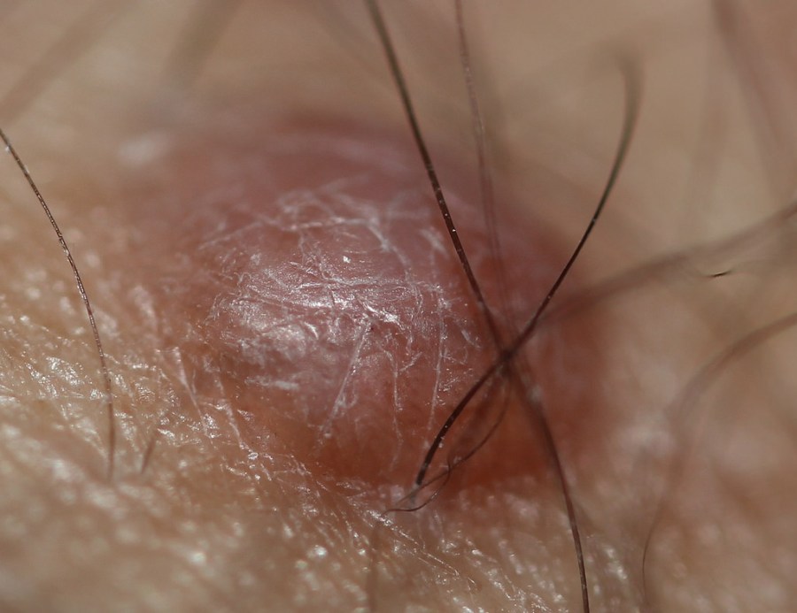 Lesión previa a la aplicación de crema con Bloodroot