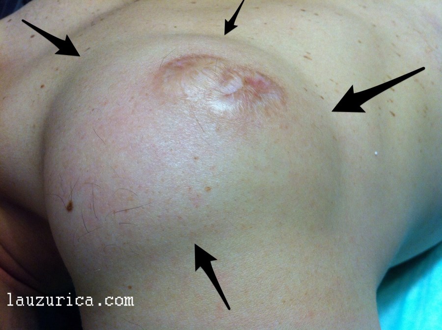 Aspecto de la masa tumoral que se intenta hacer desaparecer con crema de Bloodroot.