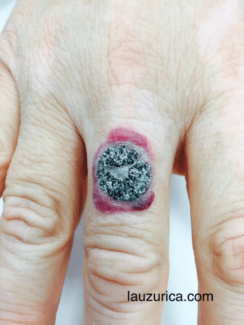 Necrosis central y ampolla periférica tras crioterapia de verruga