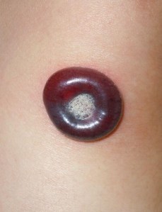 Gran ampolla tras crioterapia de verruga vírica