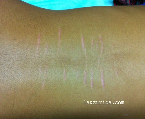 Estrías en la espalda de un adolescente.