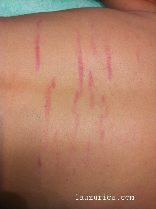 Estrías en hombro tras