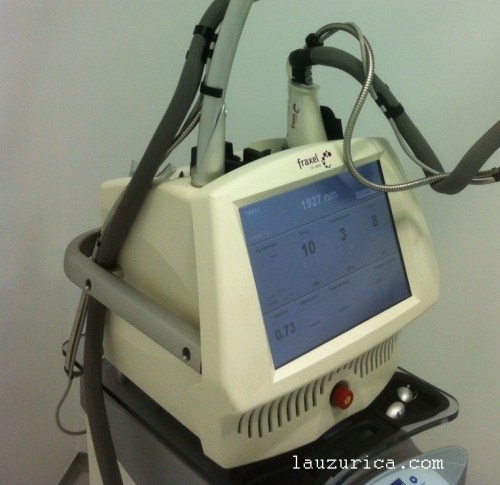 Láser fraccionado no ablativo.