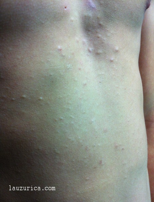 Quistes vellosos eruptivos